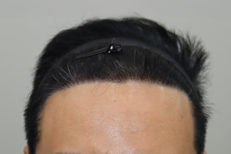 전주 헤어로의원 비절개 모발이식 2300모 9개월경과후
