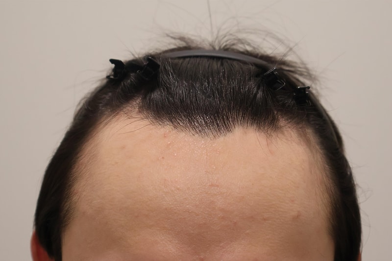 仁川ㅁㅁㅁで1300毛包6ヶ月が過ぎましたね