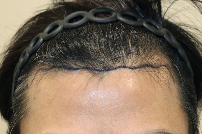 대구 헤어로의원 비절개 1800모 모발이식 9개월 후기