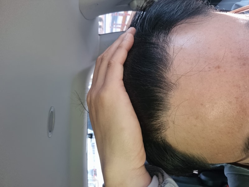 동탄 헤어로의원 비절개 모발이식 노컷 3300모 9개월 경과 후기