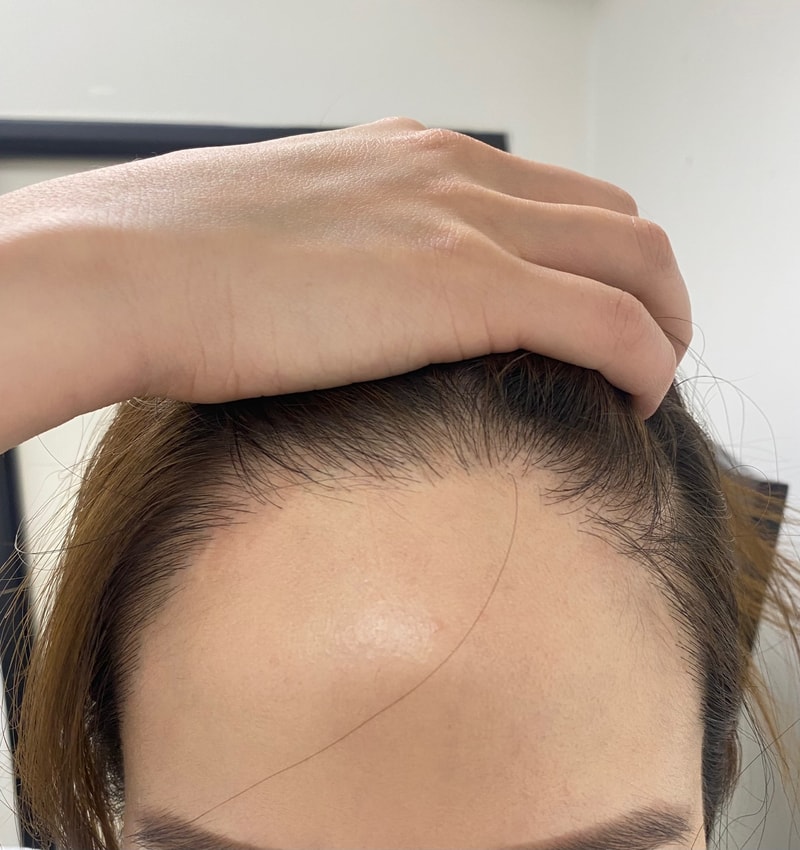 6년전에 비절개 모발이식 미국에서했어요