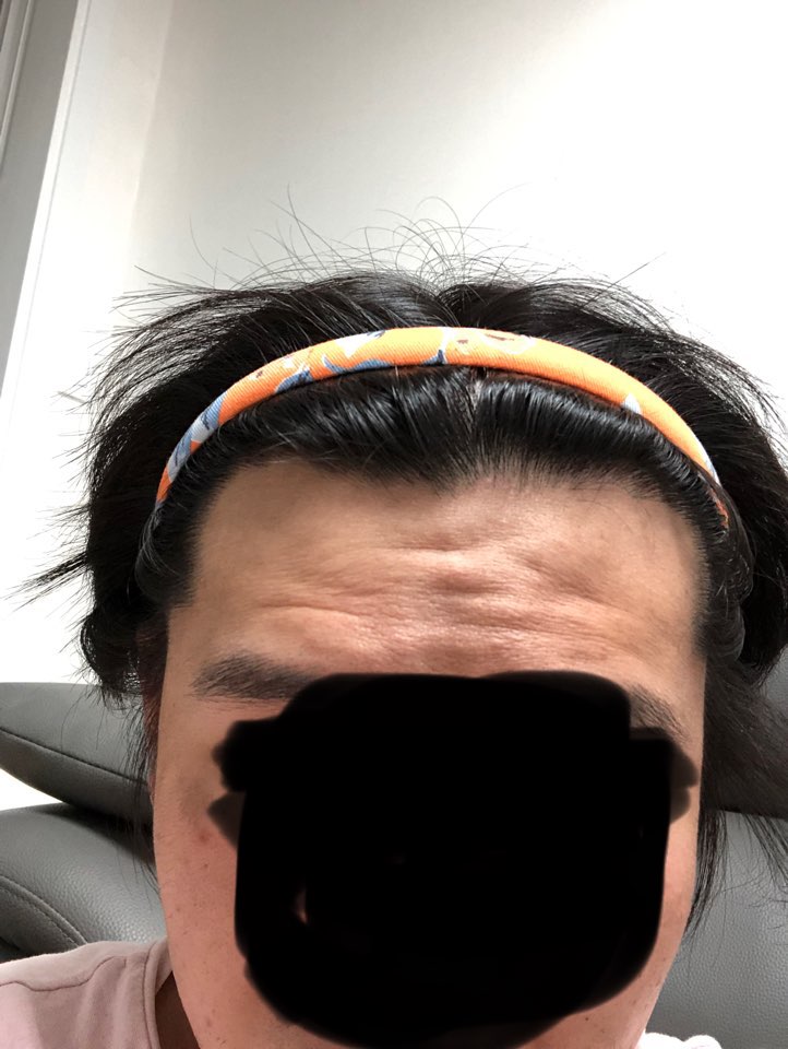 현재 밝은 곳에서 이마 깟을때