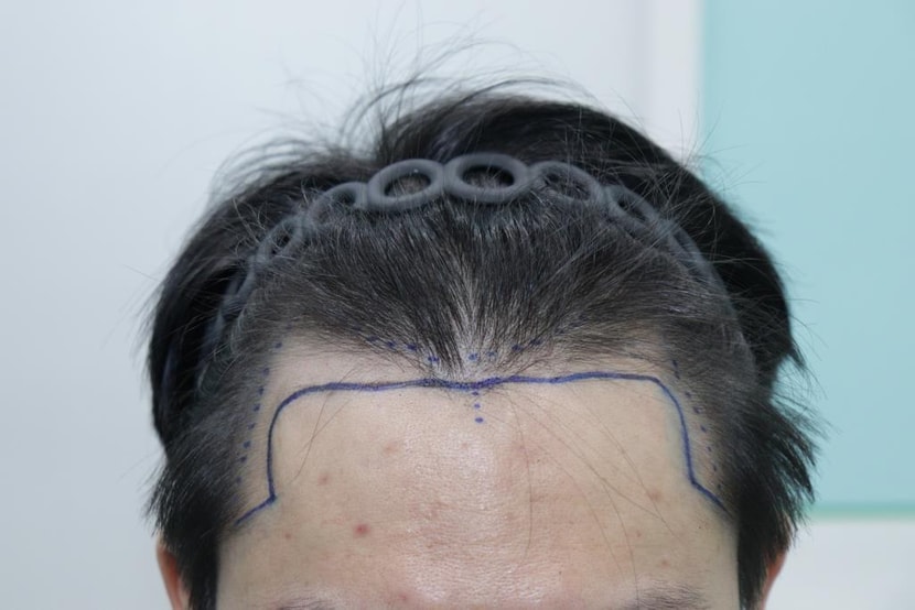 수술전 M자 진격중