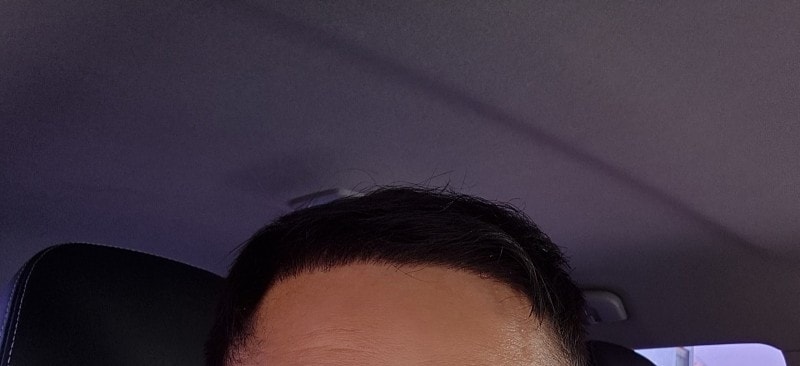 모발이식 4주차