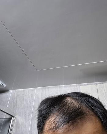 모발이식전