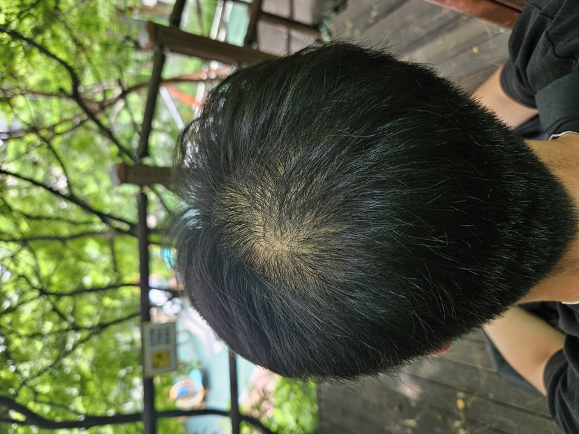 수술전1