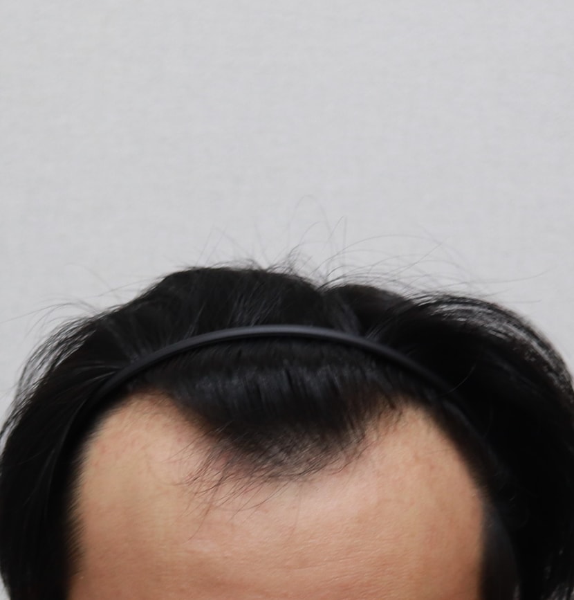 수술전