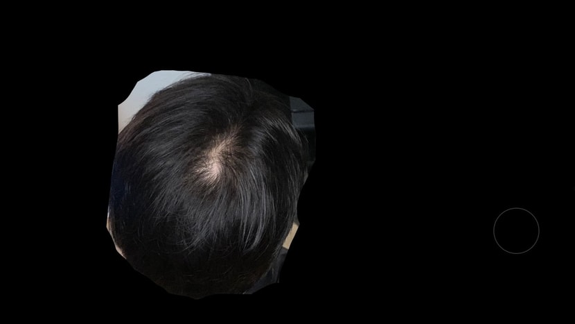 모발이식 후 정수리