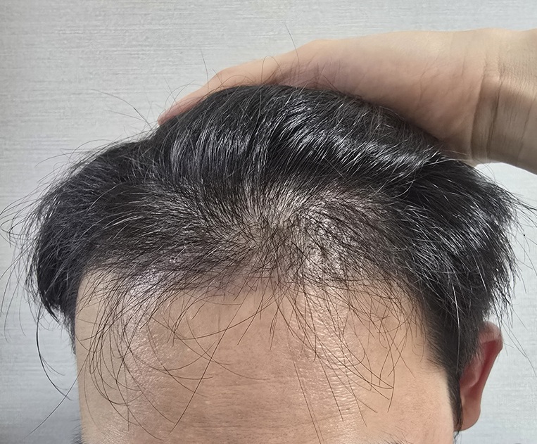 이식 전