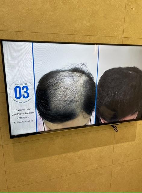 We're about to have another surgery on the forehair