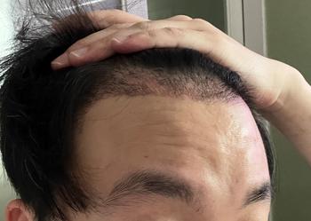 수술1달 8월 사진