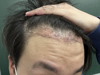 수술2달 오늘 사진