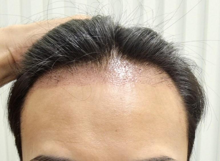 It's the dark age of men's hairline correction 1211 hair follicles