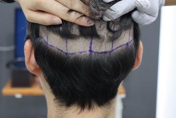 수술전 부분삭발