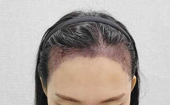 수술당일