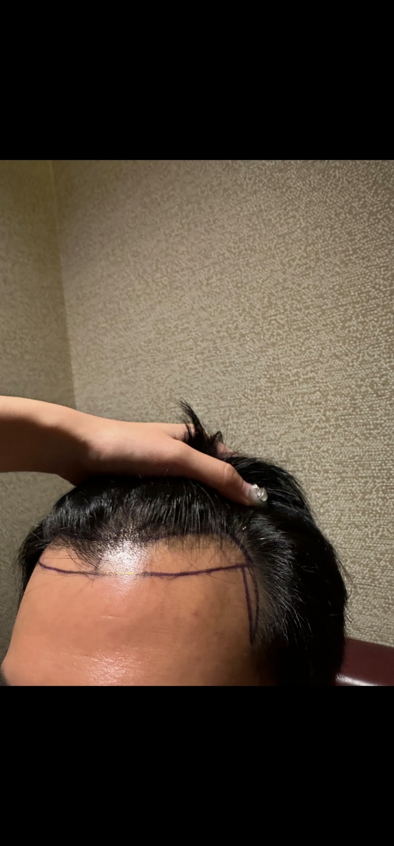 (뉴헤어 강남) 이마라인 모발이식 (절개)