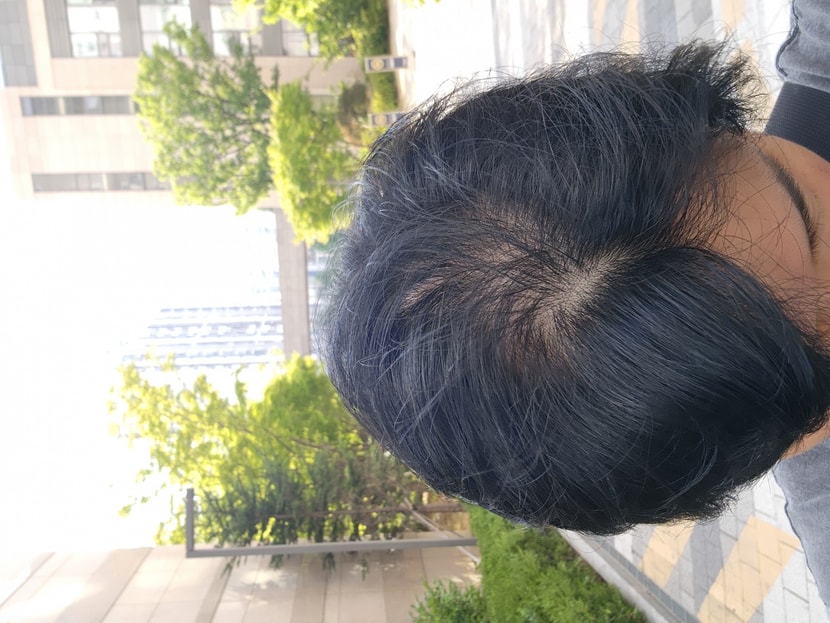 첫 수술 후 1년 뒤, 가운데 가르마 탔을때