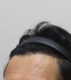 수술 후 (우측)