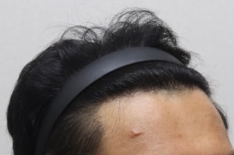 수술 후 (좌측)