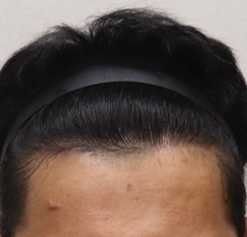수술 후 (정면)