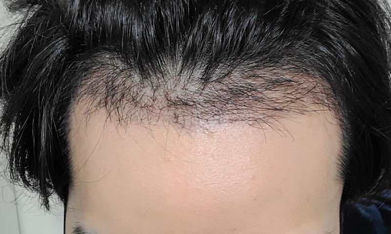 Moaman Clinic 2500 hair cut hairline 12 months late!