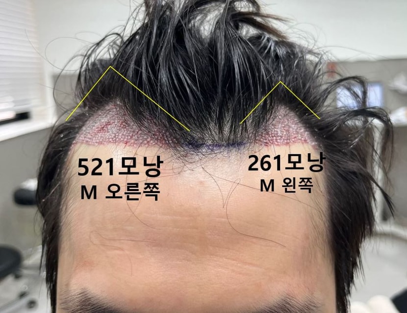 비대칭 베지터 M자탈모