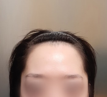 수술전