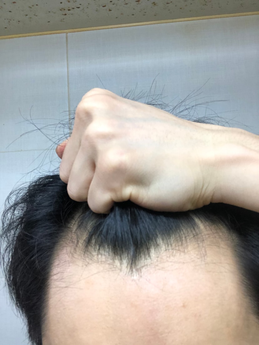 모발이식전