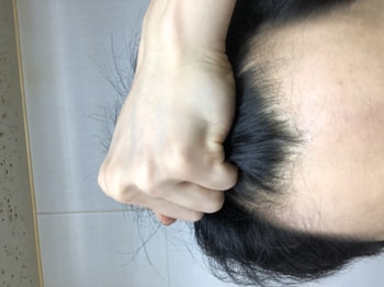이식 전