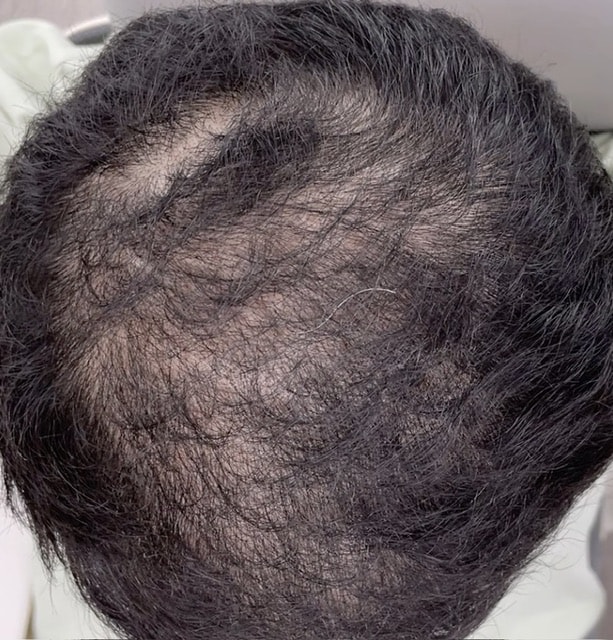 모발이식 8개월차