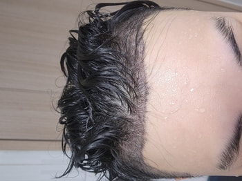 이식 후 6일차(샤워중)