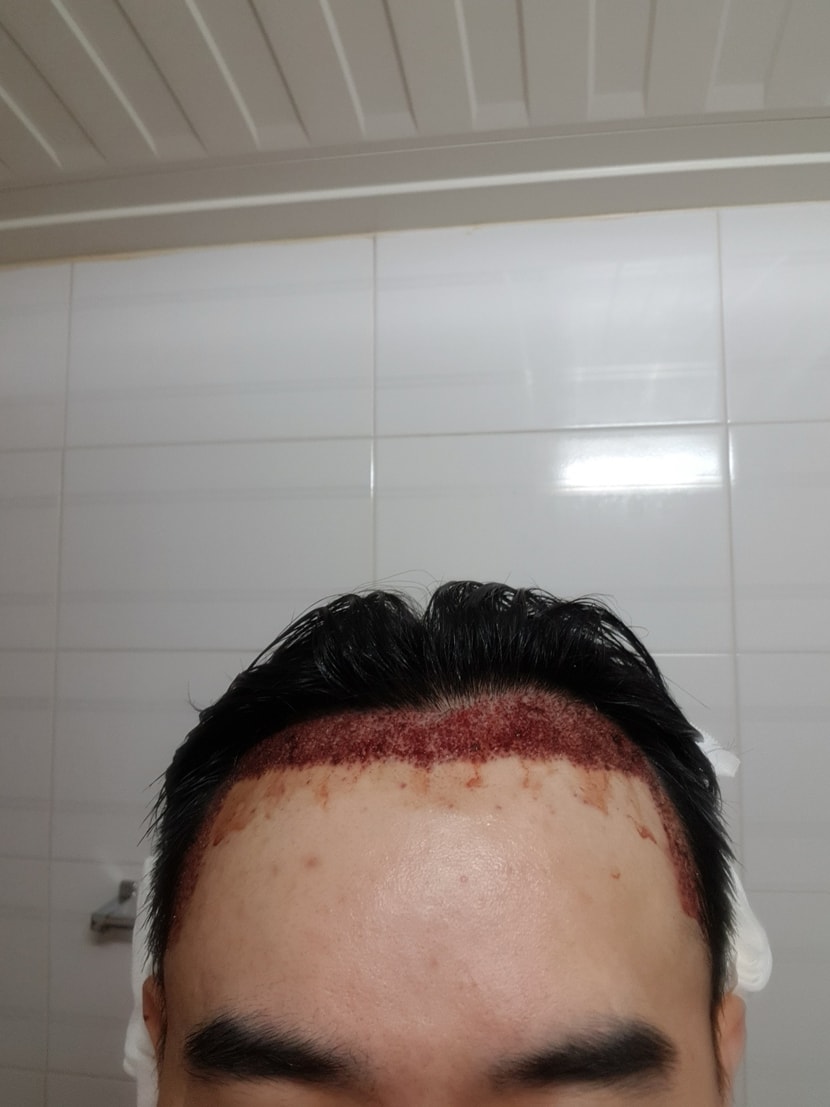 수술 당일