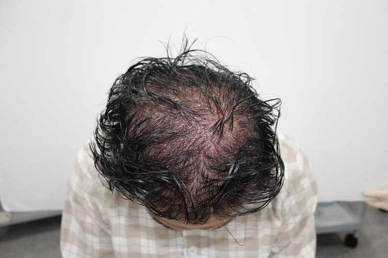 首尔moart clinic非切开设计毛发移植1600秧 后期