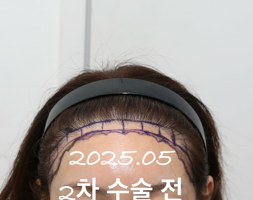 2025년 5월 2차 수술 전