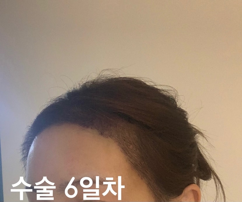 2023년 6월 1차 수술 6일차