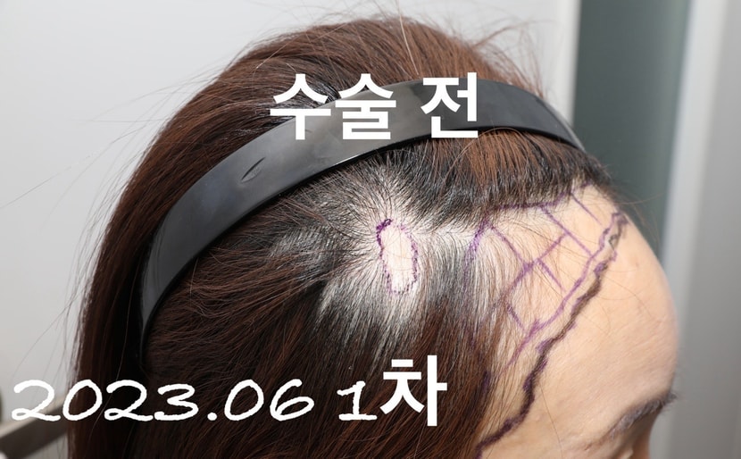 2023년 6월 1차 수술 전