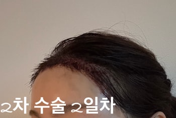 2025년 5월 2차 수술 2일차