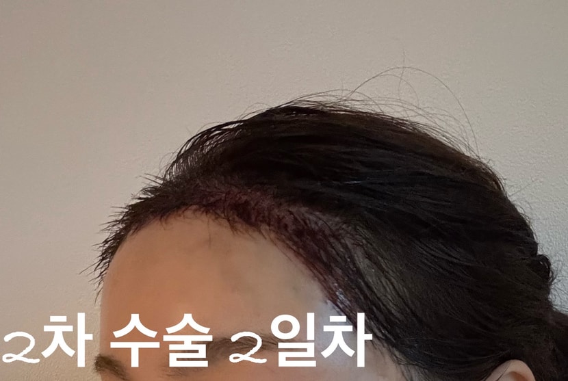 2025년 5월 2차 수술 2일차