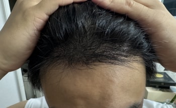 모발이식 6개월 후