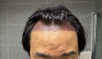 모발이식 직후
