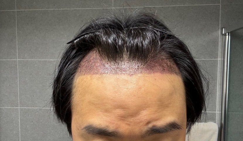 모발이식 직후