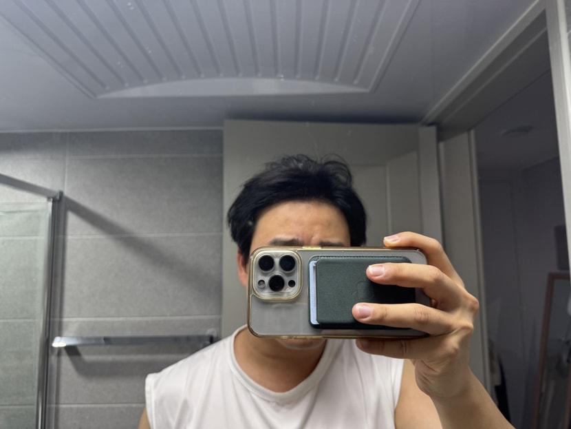 모발이식 6개월 후