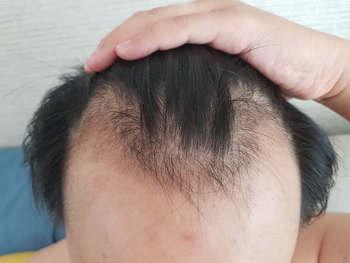 2019년 프페 복용 전(처참)