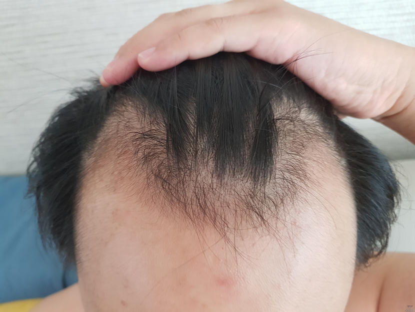 2019년 프페 복용 전(처참)