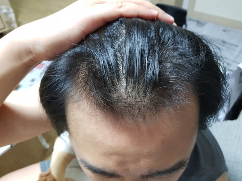 202년 프페 복용 후