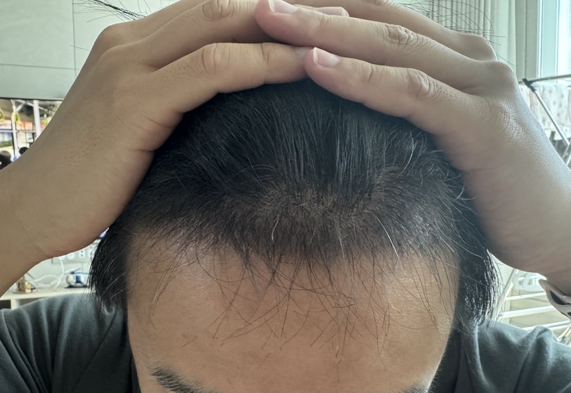 모발이식 3개월