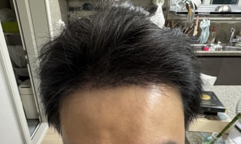 모발이식 6개월 후