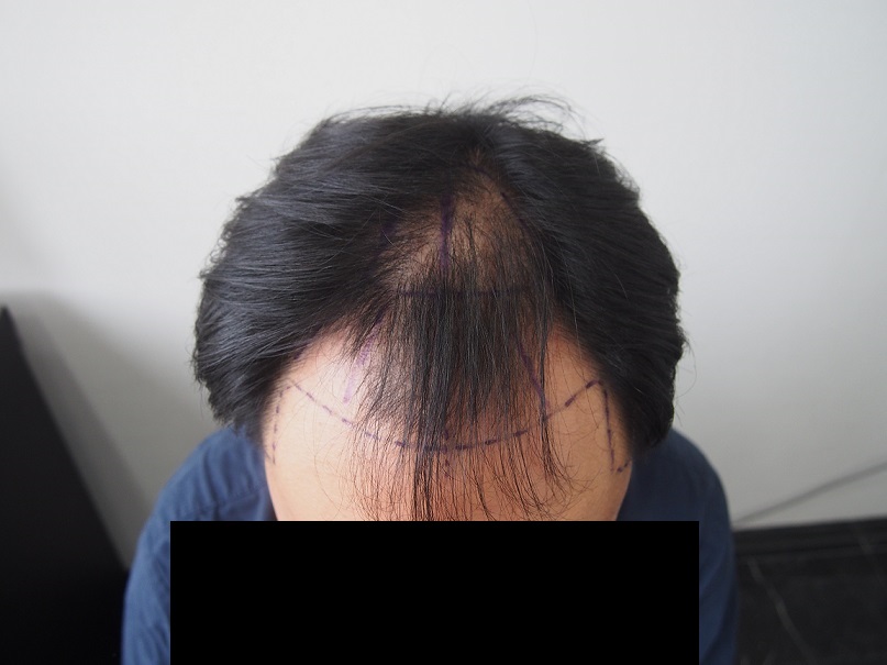 2. 수술전 상단