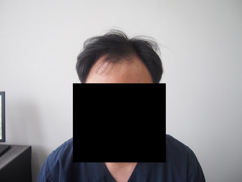1. 수술전 정면