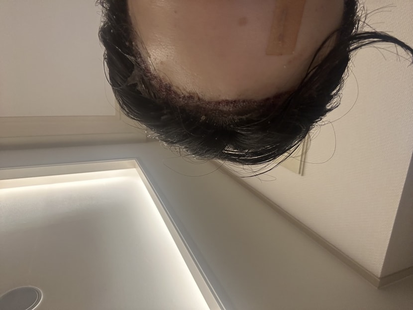 이식 중 상처가 이마에 상차가 났는데 혹시 수술중에 상처나신분들 계신가요??